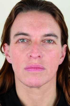 Botox voorhoofd bij vrouw