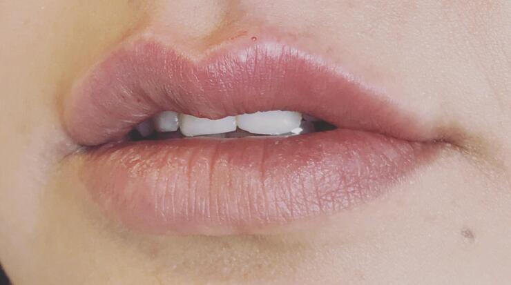 foto van lippenvegroting na behandeling