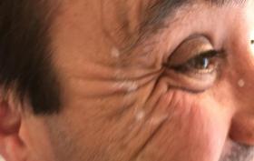 Kraaienpootjes_behandeling_man.JPG