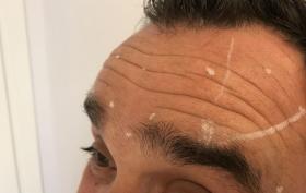 Botox_fronsrimpel.JPG