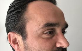 Botox_voor_mannen_Castricum_web.jpg