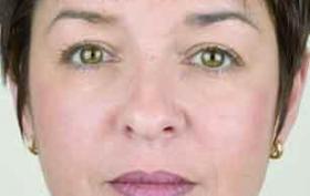 Vollere lippen na behandeling bij SBCare