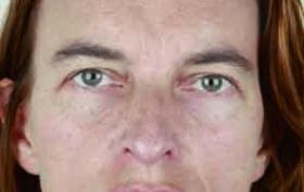 Gezicht vrouw voor injectables