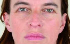 Botox voorhoofd bij vrouw