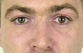 Egale Neuslippenplooi bij man