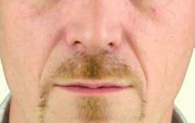 Foto voor filler behandeling bij man